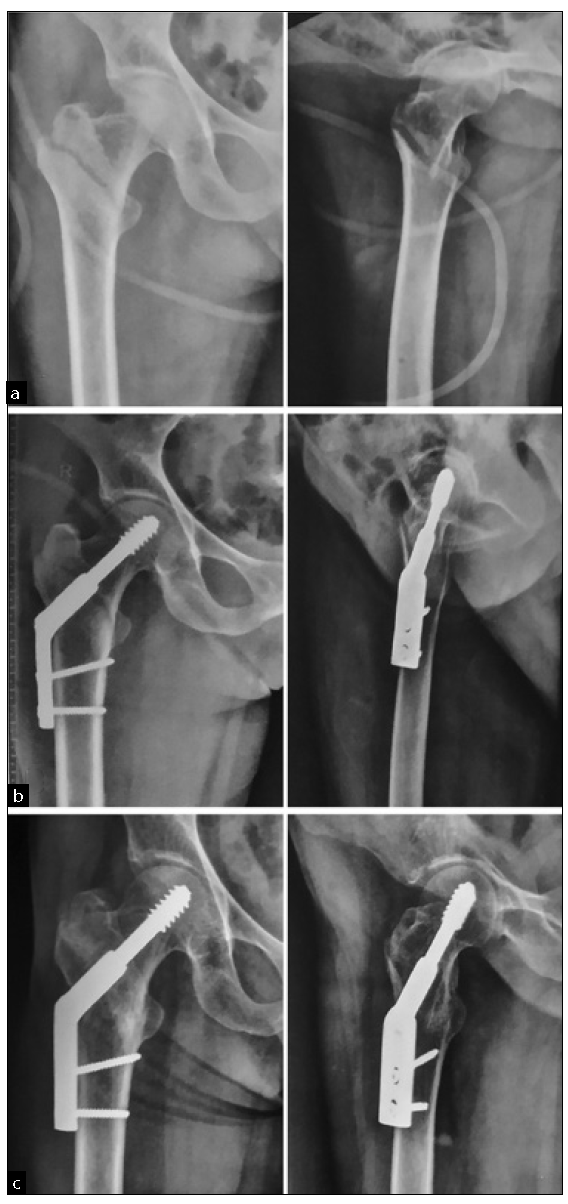 Anteroposterior and lateral images of case No 30. (a) Preoperative radiographs. (b) Postoperative radiographs. (c) Radiographs at 1 year showing union and maintained neck shaft angles.